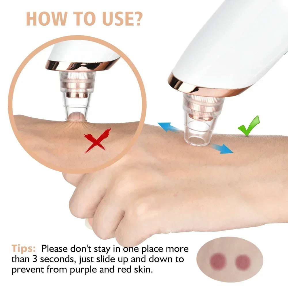 Electric Blackhead Remover Vacuum Suction - USB Facial Pore Cleaner for Acne and Pimple Extraction, Skin Care Device