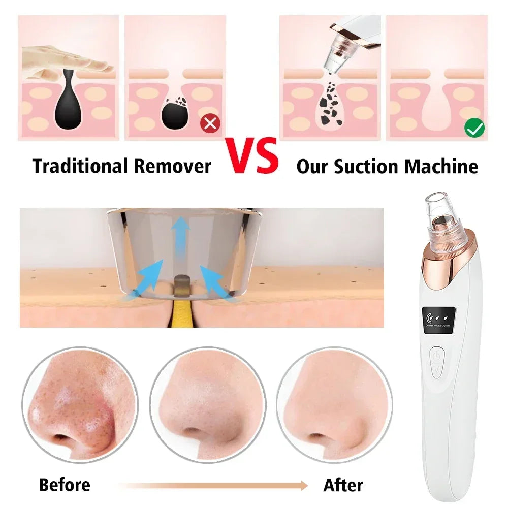 Electric Blackhead Remover Vacuum Suction - USB Facial Pore Cleaner for Acne and Pimple Extraction, Skin Care Device